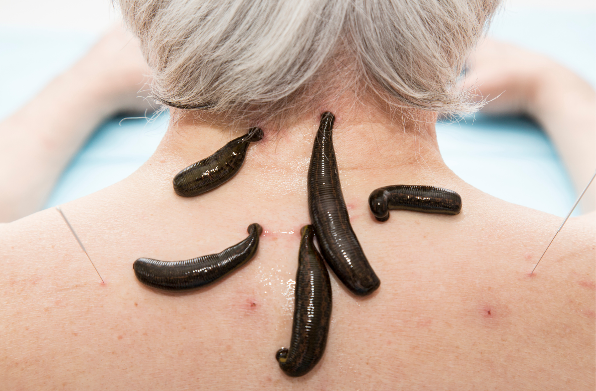 hirudoterapia zakopane